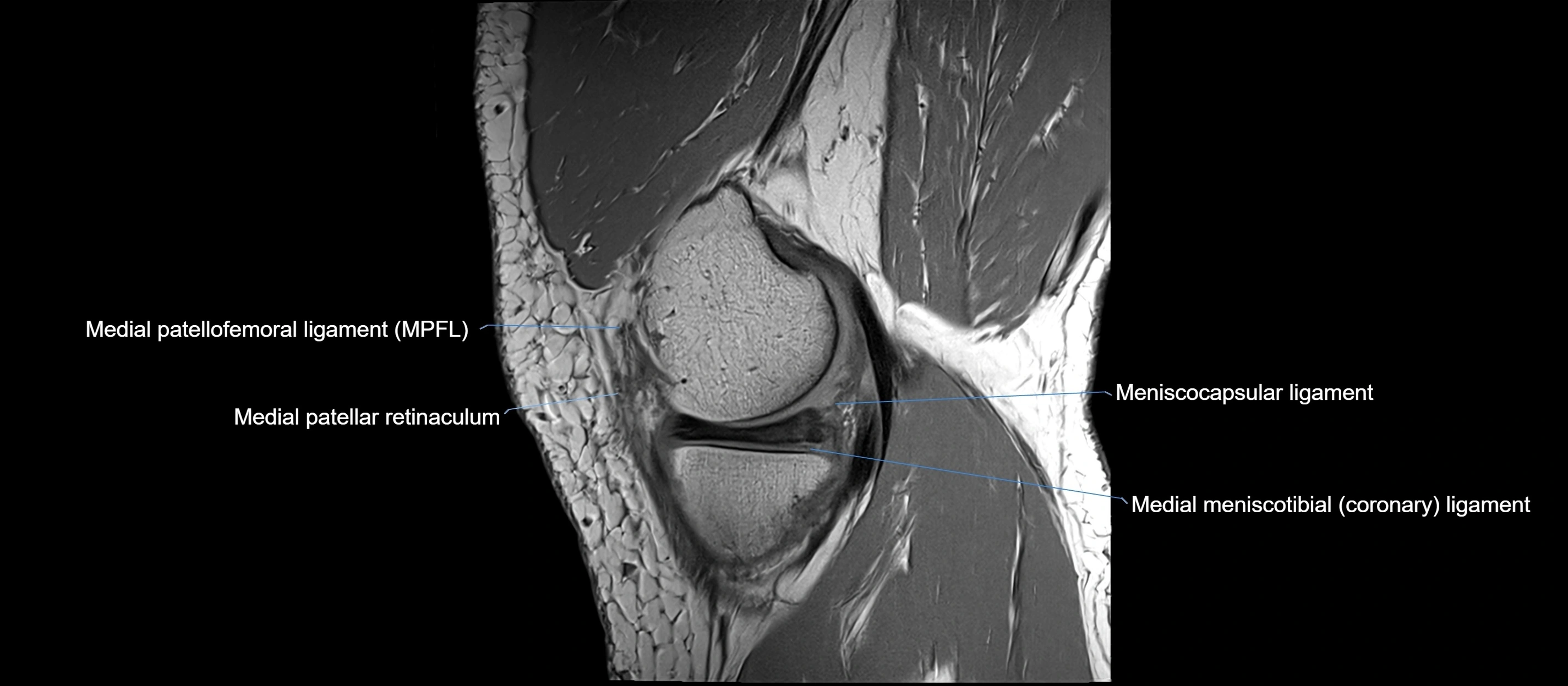 MRI sagittal  ligaments cross sectional anatomy 3T  radiology  image-img-00001-00012.webp
